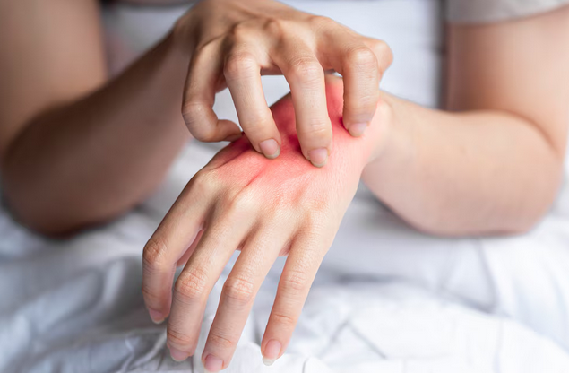 أعراض الإكزيما (التهاب الجلد التأتبي)